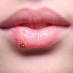 Проявления герпеса на губе