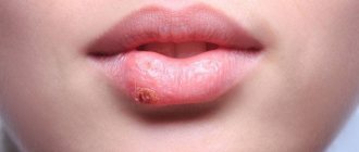 Manifestations of herpes on the lip