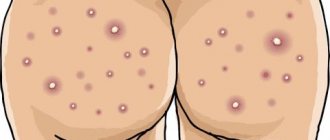 Acne on the thighs and buttocks in men: causes and treatment photo
