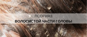 псориаз волосистой части головы