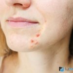 Раны на лице как противопоказание кислородной маски