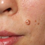 Development of papilloma on the face