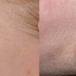 Mole or papilloma, how to distinguish