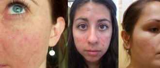 Rosacea on the face
