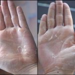 Шелушение кожи на ладонях: причины и профилактика