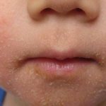 Streptoderma on the face of a child
