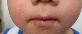 Стрептодермия на лице у ребенка