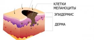The structure of a birthmark