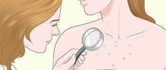 Сыпь на груди может появиться из-за аллергии