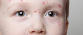 Сыпь на лице у ребенка, ее разновидности и симптомы, место локализации