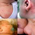 Сыпь у новорожденных деток, которая может возникать по самым разным причинам – серьезный повод для беспокойства родителей