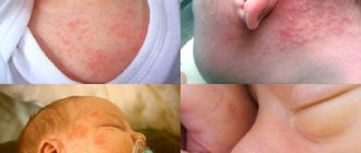 Rash in newborn babies, which can occur for a variety of reasons, is a serious cause for concern for parents.