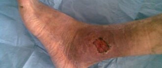 Trophic ulcer on the leg
