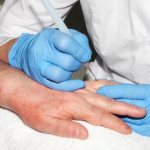 Removal of benign skin tumors using electrocoagulation