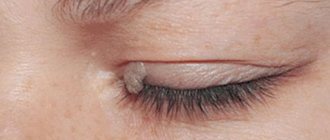 removal of eyelid papillomas