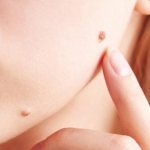 Removing moles on the face: consequences, patient reviews