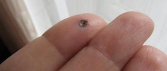 Wart removed from finger