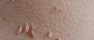 Viral warts are formed under the influence of the human papillomavirus (HPV)
