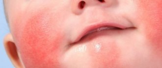 вирусный дерматит у ребенка