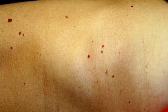 Cherry angioma: Symptoms, causes and treatments