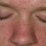 Все о причинах, симптомах и лечении себорейного дерматита на лице