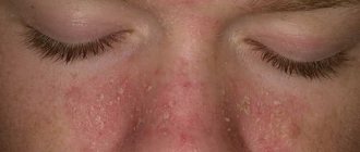 Все о причинах, симптомах и лечении себорейного дерматита на лице