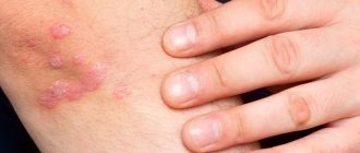 SKIN ULCERS: WHY DO THEY APPEAR AND WHAT TO DO WITH THEM?
