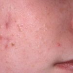 Closed comedones on the skin of the face [causes and how to get rid of them]